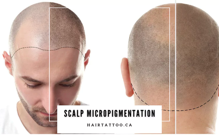 Discover the Art of SMP Hair Tattoo: Modern Solution for Hair Loss