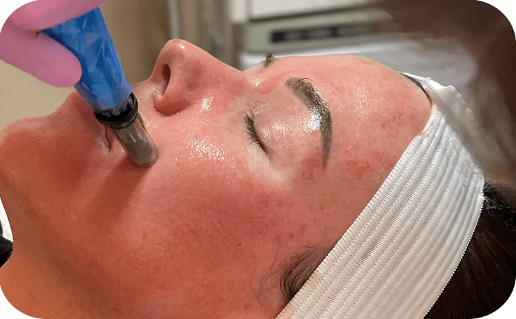 Introduction to Microneedling Face Treatment